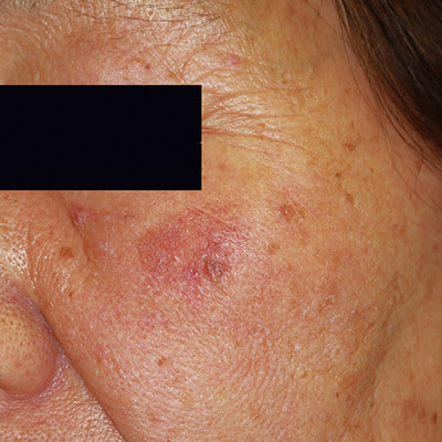 軽症：しみ、いぼ、小じわが生じている