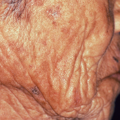 重症：しみ、いぼ、しわ、たるみが生じている